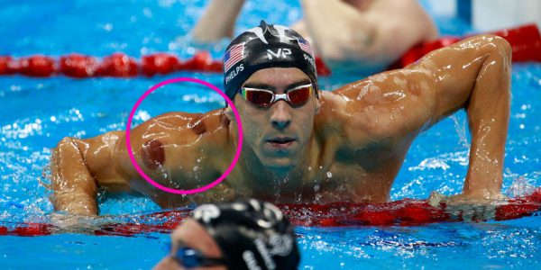 Michael Phelps has embraced cupping.